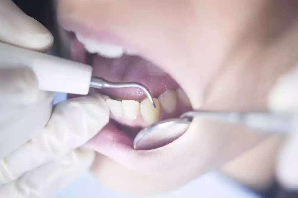 Dental Cleanings