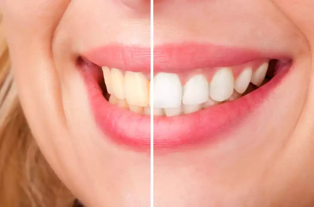 teeth whitening after care