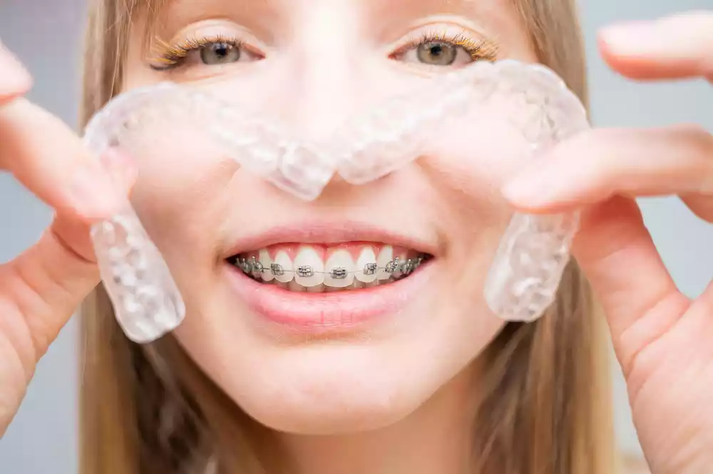Types of Retainers