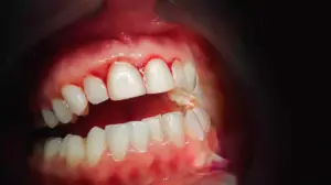 gum disease and heart health