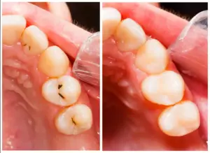 tooth decay consequences