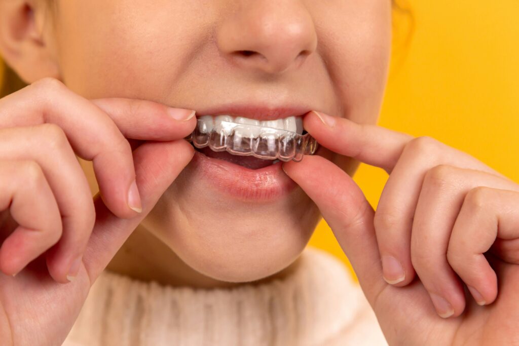 Is Invisalign worth it