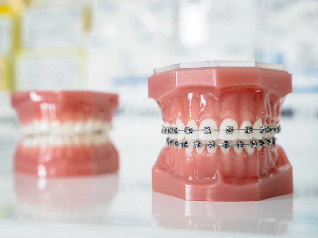 how long do braces take