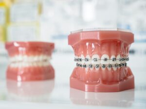 how long do braces take