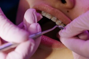 adult braces